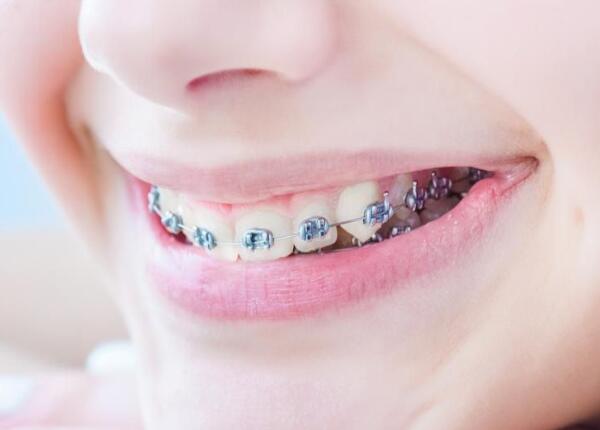 戴了牙套可以用电动牙刷吗？戴牙套的人群必看！