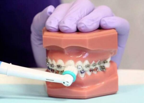 戴了牙套怎么使用电动牙刷？正确使用牙刷很重要