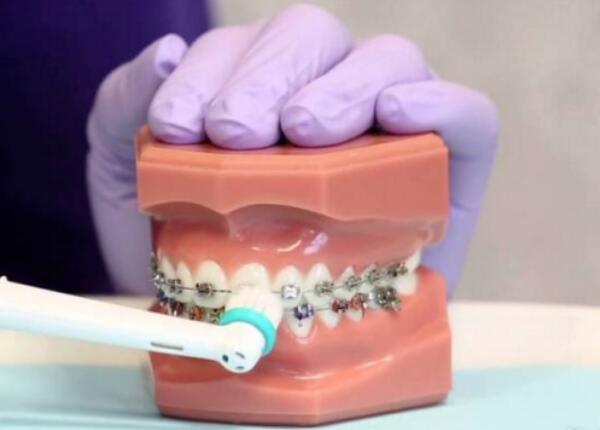 卸了牙套能用电动牙刷吗？答案就在这篇文章